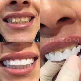 Snap-On Smile в аптеке в Араде